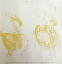 Impregnated Womb 4 &amp; 5 Months 1878 Victorian Medical Anatomy 1 Color Print DWV6B - £23.91 GBP