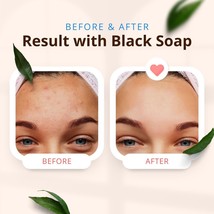 Dermatologist-Recommended Black Soap for Healthy Skin - £8.99 GBP