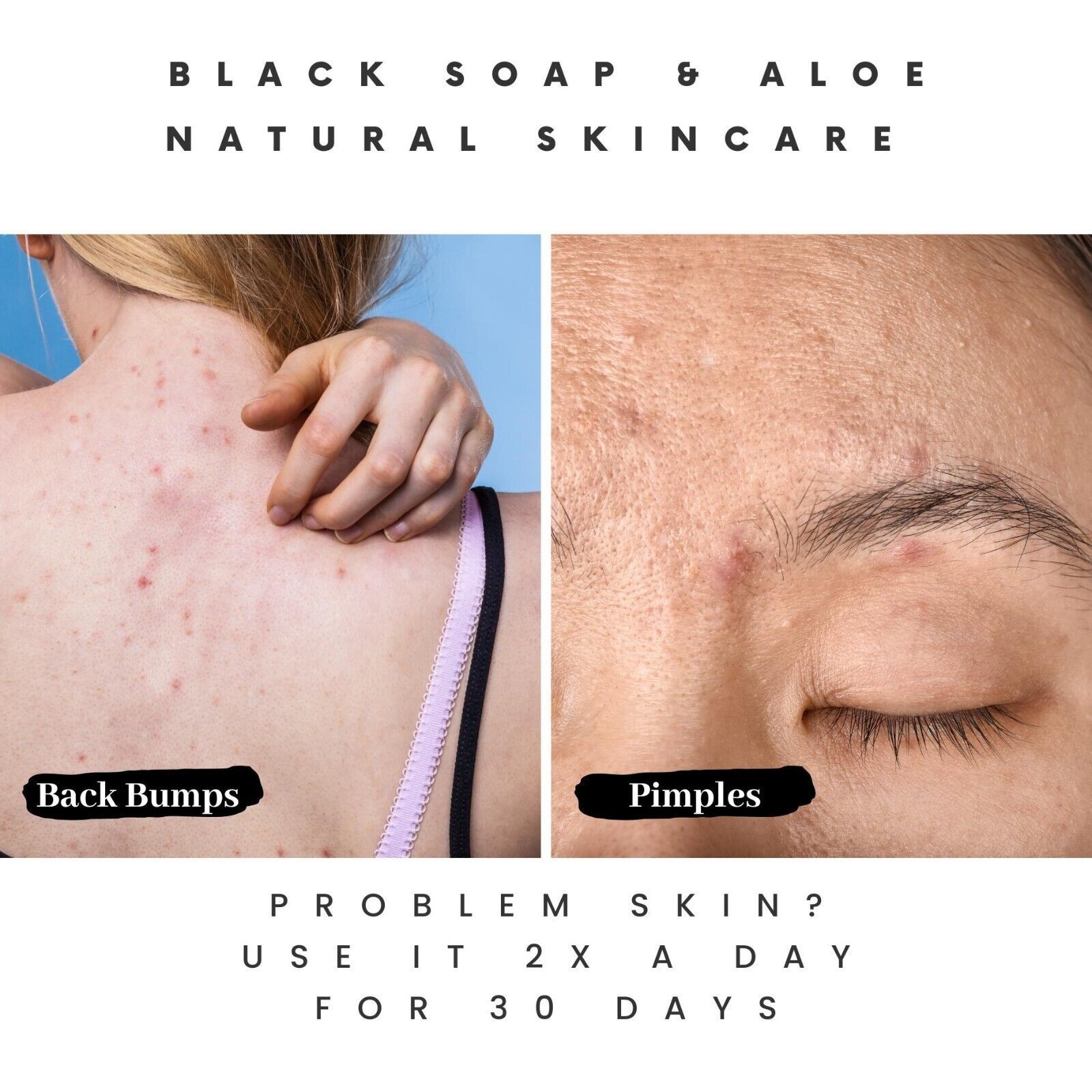 Primary image for Lather Up, Level Up: Acne Killer Liquid Black Soap