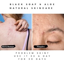 Lather Up, Level Up: Acne Killer Liquid Black Soap - £8.81 GBP