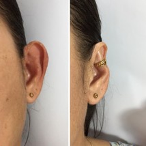 Big ears corrector - $53.00