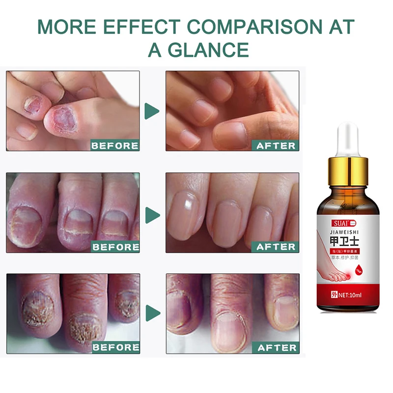 Sporting Nail Fungal Treatment Serum Onychomycosis Paronychia Anti Infection Toe - £26.37 GBP