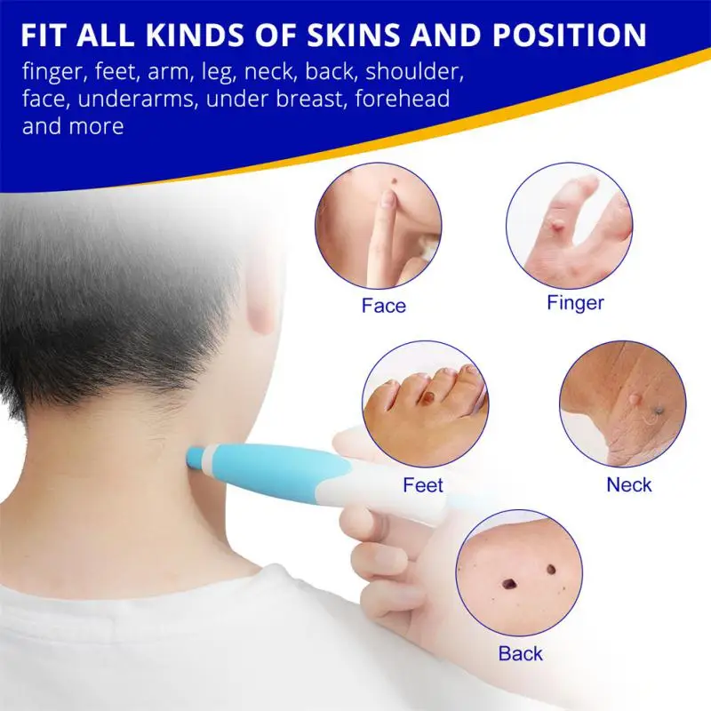 Sporting 2 In1 Painless Auto Skin Tag Mole Wart Removal Kit Cleaning Tools Face  - £23.82 GBP