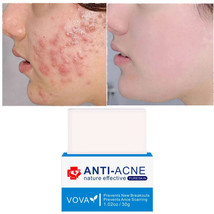 VOVA Anti-Acne Nature Effective Pure Skin - Acne Soap Bar for Breakouts Scarring - £7.18 GBP