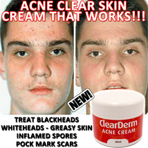 Clearderm Acne Cream Works Fast Beautiful Fresh Clearskin - £19.11 GBP