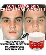 CLEARDERM ACNE CREAM WORKS FAST BEAUTIFUL FRESH CLEARSKIN - $23.99