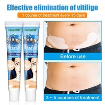 Vitiligo Ointment Psoriasis Mycosis Leukoplakia Antibacterial Anti-itch ... - $12.10