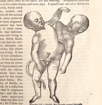 Conjoined Twins 2 Types 1878 Victorian Medical Anatomy 2 Prints DWV6B - £31.89 GBP