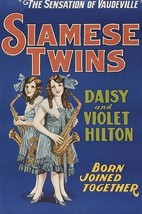 Siamese Twins - Daisy and Violet Hilton - Art Print - £17.57 GBP+