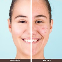 The Moisturizing Benefits of Pimple Soap - $11.28