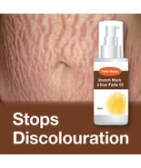 FADE AWAY STRETCH MARK &amp; SCAR FADE OIL – MAX STRENGTH STOP SIGNS OF STRE... - $490.26 MXN