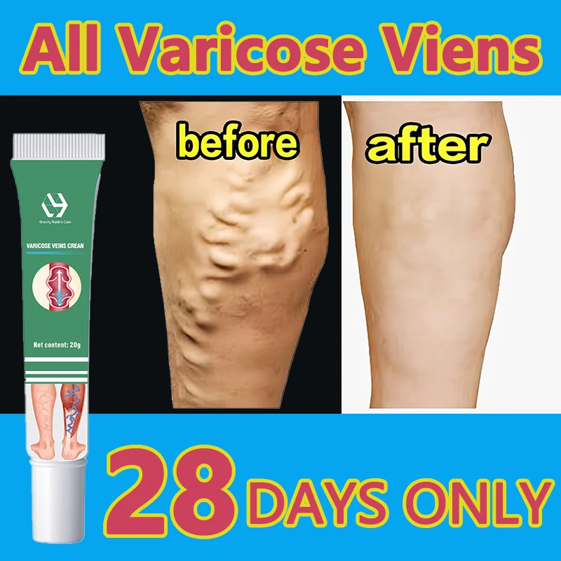 Varicose veins treatment cream varicose veins remedy and effective treat... - $27.25+