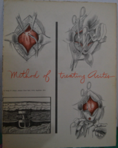 Vintage 1947 Print Illustrations &quot;Method of Treating Acites &quot; - $29.60