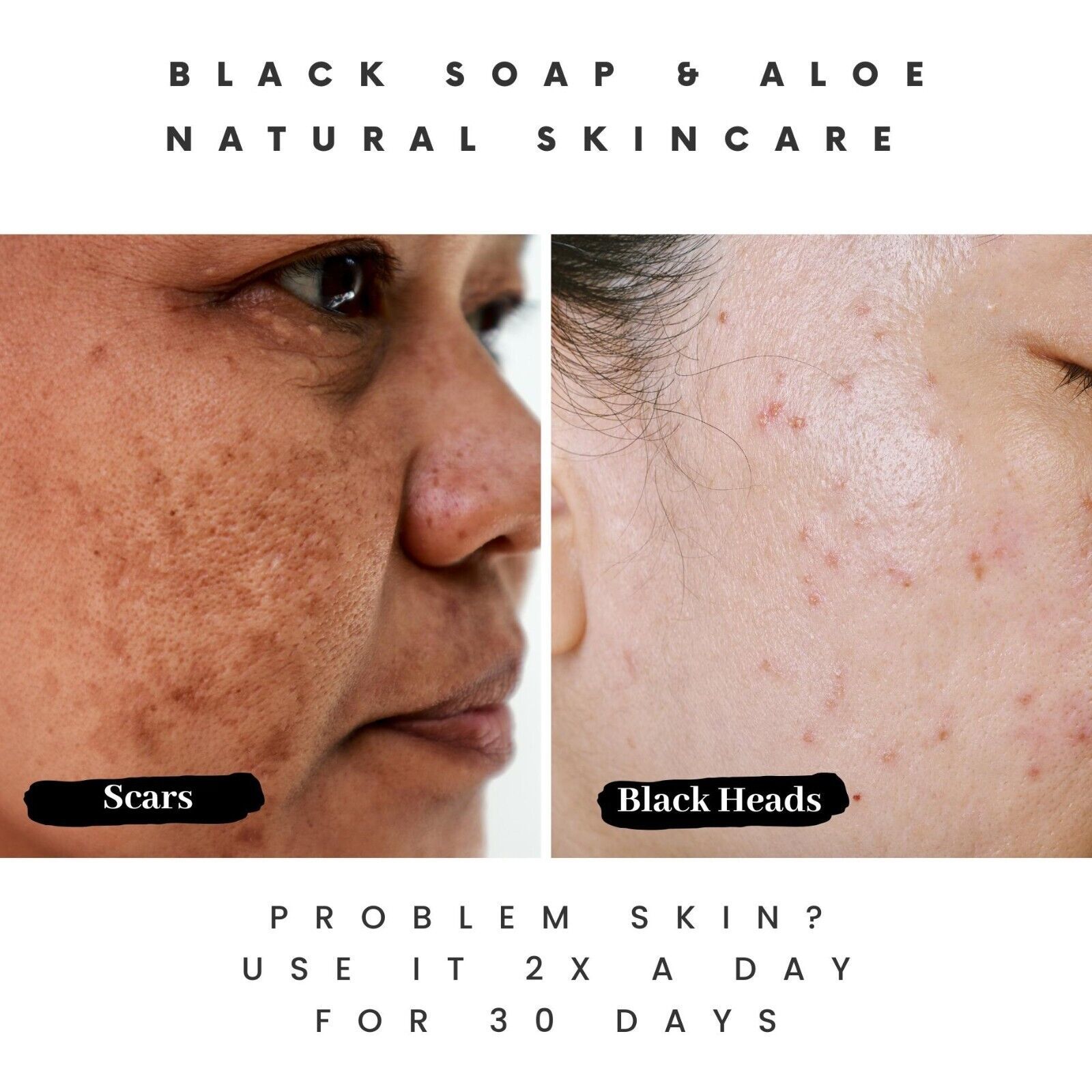 How Pimple Soap Can Help with Razor Bumps and Skin Rashes Body Soaps