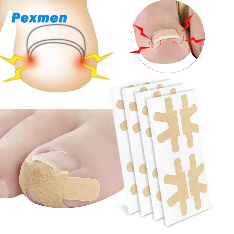 Ail correction sticker adhesive toenail patch elastic nail treatment corrector pedicure thumb200