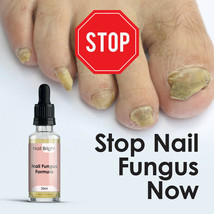 NAIL BRIGHT SERUM – FUNGAL NAIL CURE MAX STRENGTH FAST WORKING STOP FUNGUS - £19.96 GBP