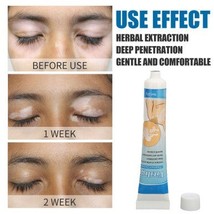 Vitiligo Cream Herbal Extract White Spots Vitiligo Treatment Ointment OMC - $12.10