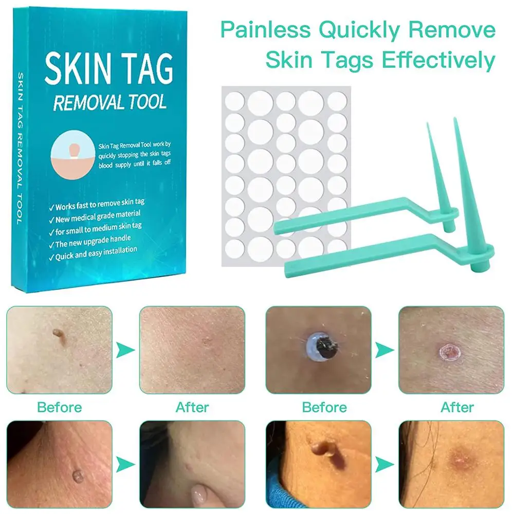 House Home Automatic Skin Tag Removal Tool Painless Natural Shedding 2 In 1 Func - £19.92 GBP