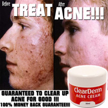 The NO.1 Clear Derm Acne Cream, Scars &amp; Blemish Cream, Clear Spots - £19.92 GBP