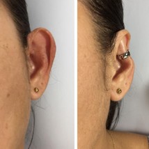 Big ears corrector - $53.00