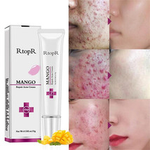 RtopR Mango Acne Whitening Moisturizing Face Blemish Cream Anti-acne Treatment - £11.98 GBP