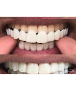 Snap On False Teeth Upper + Lower Dental Veneers Dentures Tooth Cover Se... - £13.45 GBP