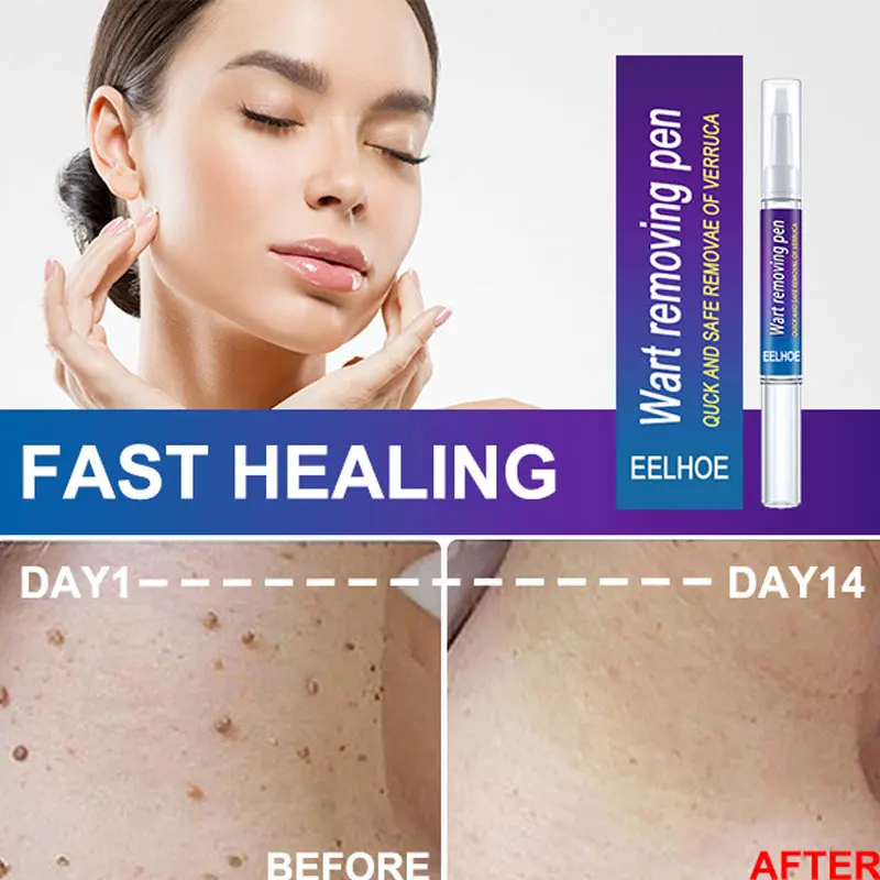House Home Skin Tag Remover A Painless Mole Skin Dark Spot Wart Removal Mole Rem - £19.92 GBP