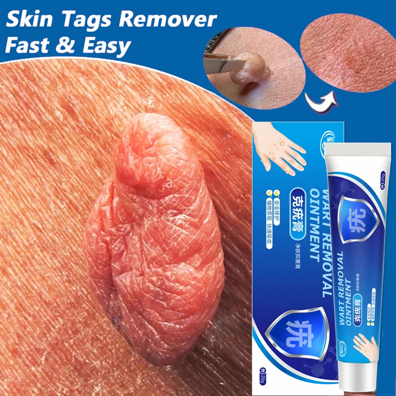  tag remover a clean painless mole skin dark spot warts remover serum freckle face wart thumb200