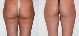 Remove Cellulite EMERGENCY Spell Casting Skin Stretch Marks Scars Baby Mom Body - £55.05 GBP