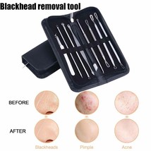 9 Piece Blackhead Cleaner / Remover Acne/Comedone Extractor Tool Easy Ex... - £13.36 GBP