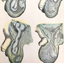 Varieties Of Scrotal Hernia 1878 Victorian Medical Anatomy Color Print DWV6A - $49.99