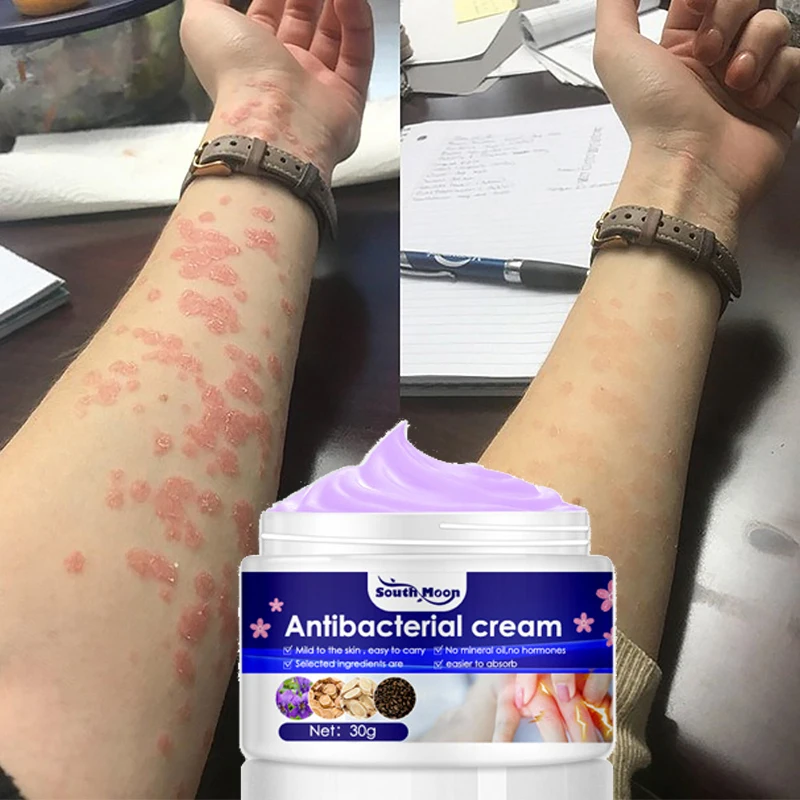 Sporting Psoriasis Antibacterial A Dermatitis Eczematoid Ointment Effective Anti - £27.56 GBP