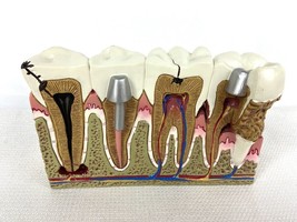 Bad Teeth Cross Section Anatomical Model - £38.33 GBP