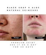 Pimple Soap: A Solution for Acne and Hyperpigmentation - $13.62 CAD