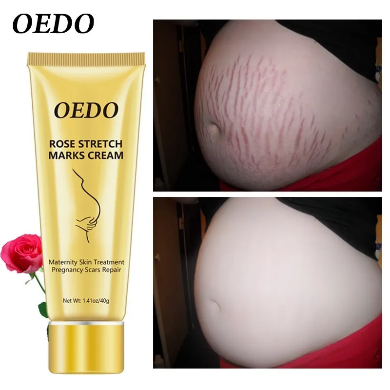 Sporting OEDO Rose Remove Stretch Marks A Maternity Body care Stretch marks Remo - £24.85 GBP