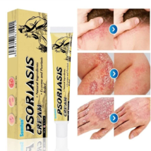 Crema Para Dermatitis Eczema Psoriasis Para Comezon Picazon Ronchas En L... - $18.95