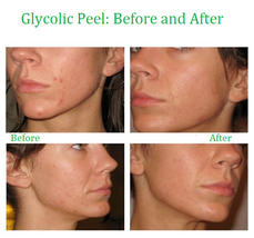 Glycolic Acid Face Peel Kit Medical Grade Pure Acne Scars Wrinkles Anti-Aging - £6.49 GBP+