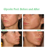 Glycolic Acid Face Peel Kit Medical Grade Pure Acne Scars Wrinkles Anti-... - £6.38 GBP+