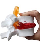 Human Anatomical Lumbar Disc Herniation Model - Lumbar Spine Model for T... - £61.91 GBP