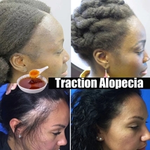 Africsn Grazy Has Growth Alopecia Chebe Powder Thicken Shampoo Hair loss... - £19.57 GBP