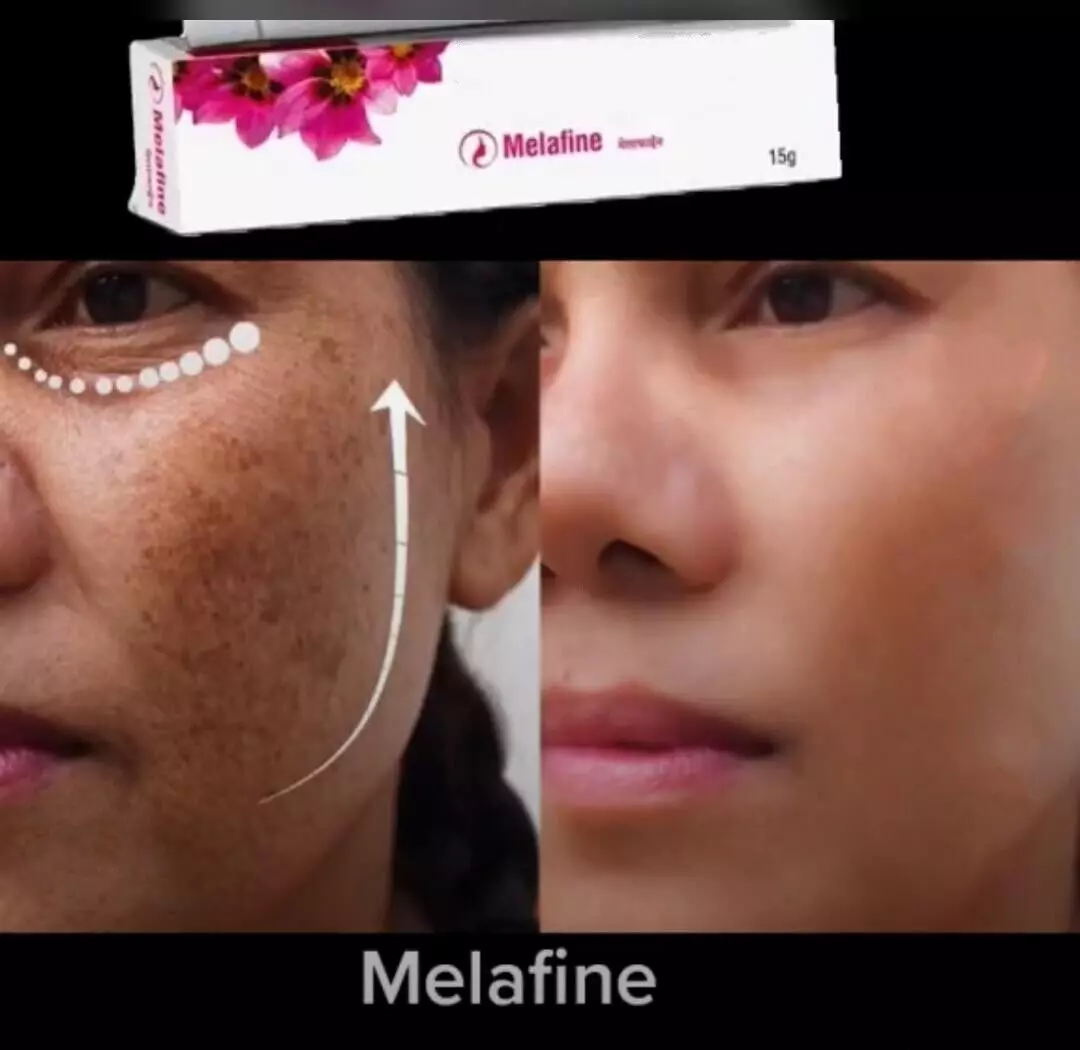 Anti aging Cream,Skin Brightening,Melasma treatment,Wrinkles,Even skin t... - $34.48 CAD