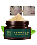 EFICAZ Crema para el acné ELIMINA Espinillas Espinillas Manchas hombres ... - $18.95