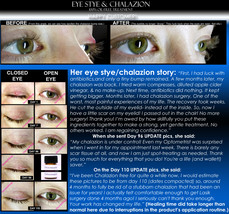 BEST Eye Stye Treatment and Chalazion Treatment 2 IN 1 Product Oil-Free  - $32.99
