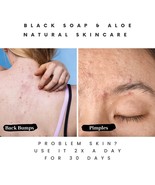 How Black Soap Can Improve Your Skin Health - $9.89