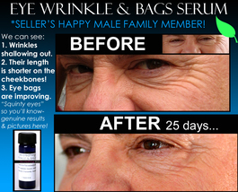 Best Natural Eye Wrinkle Treatment &amp; Eye Bags Treatment 2 In 1 Product - £28.43 GBP