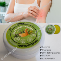 Dermatitis Eczema Cream Antibacterial Itchy Rash Dry Skin Rosacea Treatment Balm - $27.99