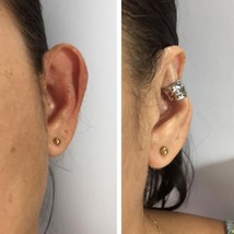 Big ears corrector - $53.00