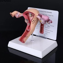 Pathological Uterus and Ovary Anatomical Model Human Female Medical Anatomy - $37.38