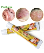 2pcs Skin Psoriasis Cream Dermatitis Eczematoid Eczema Ointment Treatmen... - £14.10 GBP
