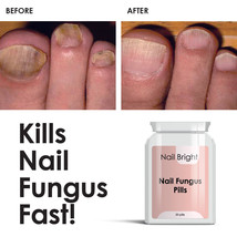 Nail Bright Pills - Nail Fungal Cure Stop Fungus Dry Brittle Crumbing Nails - £19.88 GBP